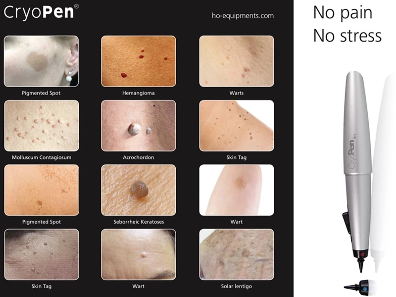 CryoPen device with multiple treated skin lesions